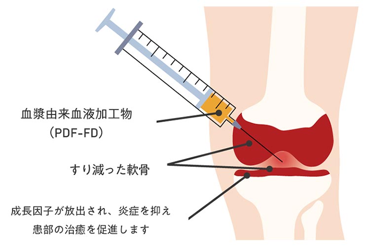 PDF-FD療法